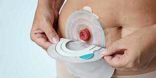 Articles onliving with an ostomy bag. Changing Your Colostomy Bag