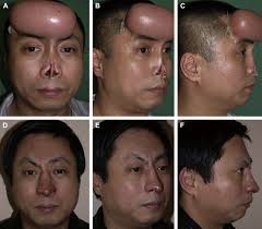 Anchor-shaped nasal framework designed for total nasal reconstruction