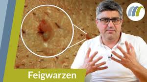 Warzen Am Penis So Gehen Sie Wieder Weg Urologie Am Ring Youtube