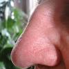 Sommersprossen — sommersprossen , die an stirn , nase , im übrigen gesicht , an den armen bei personen mit seiner , weißer oder krankhaft bleicher haut im sommer vorkommen und oft im winter. 1