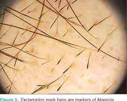 Maybe you would like to learn more about one of these? Figure 5 From Dermoscopy In The Diagnosis Of Hair And Scalp Disorders Semantic Scholar