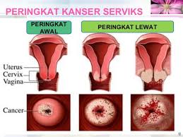 Obat herbal pertama untuk sakit pinggang adalah bisa menggunakan asam jawa. Kanser Serviks