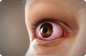 Image result for Proptosis