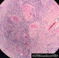 Also called an epithelial pearl, due to a location among squamous cells of the epithelium, this type of structure is sometimes seen with squamous cell carcinoma. Jerad Gardner Md On Twitter Keratin Pearls In An Invasive Squamous Cell Carcinoma Pathology Dermpath