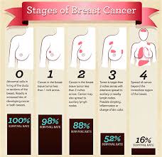 Stage i cancer typically means the cancer is small and localized to one area, and that it has not spread to the lymph nodes or other parts of the body. Breast Cancer Stages Symptoms Of Stages And Survival Rate