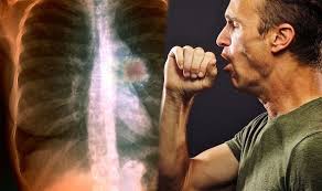 Lung cancer may not cause any signs or symptoms in its early stages. Lung Cancer Symptoms Signs In Your Cough Of The Deadly Disease Express Co Uk