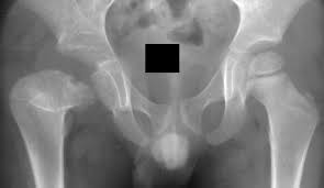 Image result for Septic Joint