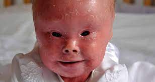 • nonmodifiable risk factors for atherosclerosis: Harlequin Ichthyosis Photos And Stories Of The Rare Skin Disease