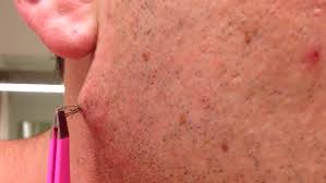 People who frequently shave their heads often experience ingrown hairs on top of head, back of head, along the side, and the upper portion of the neck. Yes You Could Have An Ingrown Hair This Bad On Your Bikini Line