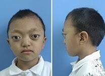 Clinical features of a 6-year-old boy with Crouzon syndrome....