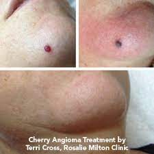 Cherry angiomas are benign lesions caused by dilation of tiny blood vessels and are most often found in this is why it is essential for anyone seeking treatment to have their lesions evaluated by an. Cherry Angioma Rosalie Milton Clinic Doctors In Paddington Doctors In Milton