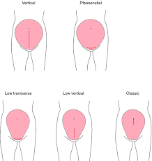 Cesarean Section Definition Of Cesarean Section By Medical Dictionary