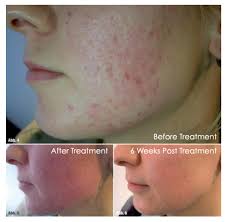 I tried it to find out. Microneedling For Acne Scars At Laser Skin Institute Chatam Nj