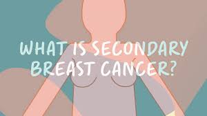 During the test, a needle is inserted into your bone to remove a sample of your bone marrow. Secondary Breast Cancer In The Bone