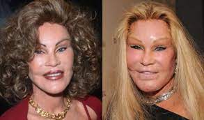 Anna is a communication expert and a life enthusiast. Plastic Surgery Gone Wrong Bad Celebrity Plastic Surgery