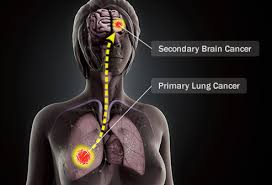 Visual Guide To Brain Cancer