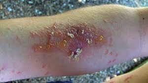 The fruits are excellent in pies and crumbles. Poison Oak Ivy And Sumac Plants That Make Us Itch Owlcation
