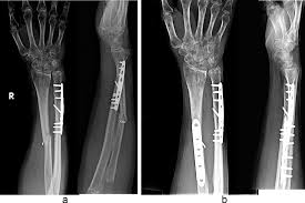 Alternativt kan tfcc vara avlöst från radius. A Five Weeks After Her Ulnar Shortening Osteotomy Arthroscopic Download Scientific Diagram
