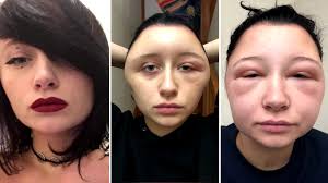 Such interactions may enhance the therapeutic effects of other medications being taken, resulting in undesired side effects. Woman S Head Doubled In Size After Allergic Reaction To Ppd In Hair Dye Health Com