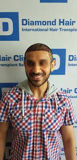 Our team of experts have done more than 10 000 hair transplants in our fully equipped hospitals in sweden and turkey. 5500 Grafts Sapphire Fue Ht Diamond Hair Clinic Dr Mehmet Demircioglu 22 June 2020 Hair Transplant Hairsite Hair Restoration Forum