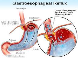 Although caffeine is commonly considered to have an impact on this muscle, this problem exists with decaffeinated coffee too. Beyond Food What Triggers Heartburn And Gerd