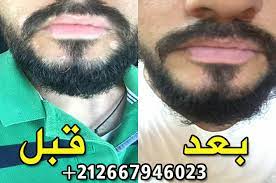 • клобетазола пропионат 0,5 мг/г. Clovate 0 5mg G Crema ÙƒÙ„ÙˆÙØ§Øª ÙƒØ±ÙŠÙ…Ø© Vitiligo Treatment Vitiligo Skin Vitiligo