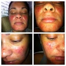 DERMATOLOGY ASSOCIATES OF ATLANTA