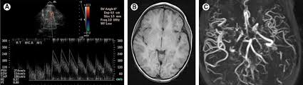 Childhood Moyamoya Disease And Moyamoya Syndrome A Pictorial Review Sciencedirect