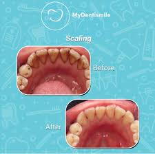 Lalu berkumur menggunakan air hangat sampai dengan 2 menit, setelah itu buang jangan sampai ditelan. Mau Menghilangkan Karang Gigi Dental Scaling Solusinya Mydentismile