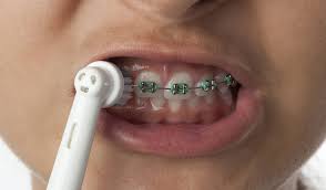 How to brush your teeth. Can You Use An Electric Toothbrush With Braces Voss Dental Oral Surgery Implant