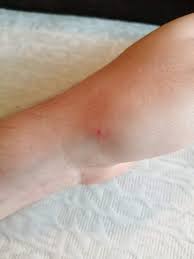 Image result for Bat Bite