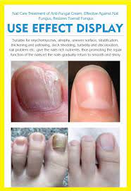 Pin By Maria On Remedio Para Varizes Nail Fungus Treatment Nail Repair Nail Fungus