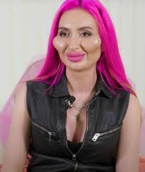 This Instagram model is fearlessly embracing her bold and unique look!  Anastasiia, 36, proudly claims to have the "biggest cheeks in the world"  and isn't planning to stop anytime soon. Since getting
