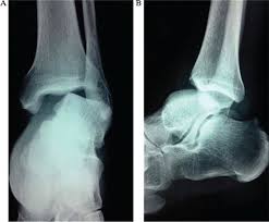 Image result for Ankle Dislocation