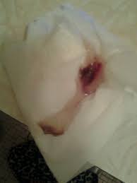 Is It Normal To Keep Losing Big Globs Of The Mucus Plug Graphic Babycenter