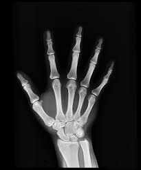 The carpal bones are the eight small bones that make up the wrist (or carpus) that connects the hand to the forearm. Hand X Ray