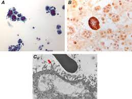 Get the facts on mesothelioma types (pleural, peritoneal, pericardial), causes (asbestos), cancer diagnosis, prognosis, staging, life expectancy, and treatment information. Pleural Well Differentiated Papillary Mesothelioma A Case Report Journal Of Thoracic Oncology