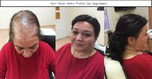 Saclarinizin Dokulmelerinden Sikayetci Misiniz Bu Sorununuzdan Rahatlikla Kurtulabilirsiniz Hemde Agrisiz Cerrahi Hicbir Islem Gormed Kadin Sac Sac Dokulmesi