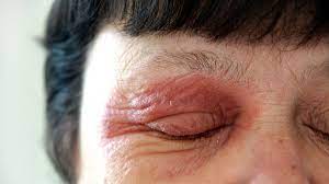 Though the duration of this condition can last two to four weeks or even longer, it may take only minutes for the rash to develop. Eczema Eye Complications How To Protect Your Vision Everyday Health