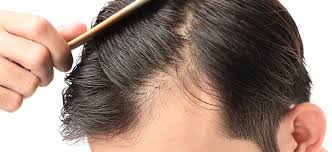 For those experiencing hair loss, medication is one of the most popular treatment options. Finasteride Vs Minoxidil Which Men S Hair Loss Treatment Is Best Fox23 News