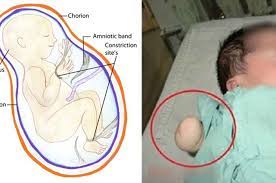 Maybe you would like to learn more about one of these? Air Ketuban Sedikit Tangan Sang Bayi Terputus Dalam Rahim Ibunya