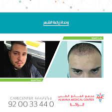 وحدة زراعة الشعر في مستشفيات المانع