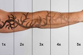 Nowadays, most tattoos are removed through a series of laser treatments. Evolution Laser Clinic Treatment Prices