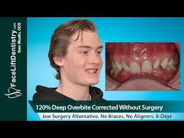 Otc devices and things you see online often push teeth too much, too little, or don't. Overbite Fix No Braces No Aligners No Surgery 8 Days