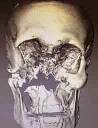 We would like to show you a description here but the site won't allow us. Opmerkelijk Herstel Na Jetski Ongeval De Standaard Mobile