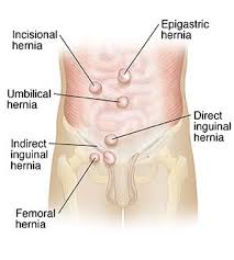 Image result for Inguinal hernia man