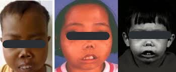 Ciri Ciri Dan Pencegahan Thalassemia Ade Ufi