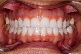My Front Tooth Is Hitting My Bottom Lip Blue Court Dental Centre Harrow