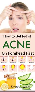 Small bumps on your face can be hard to identify. How To Get Rid Of Acne On Forehead Overnight 11 Best Acne Remedies