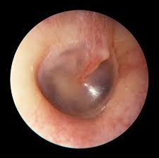 Image result for Eustachian Tube Dysfunction